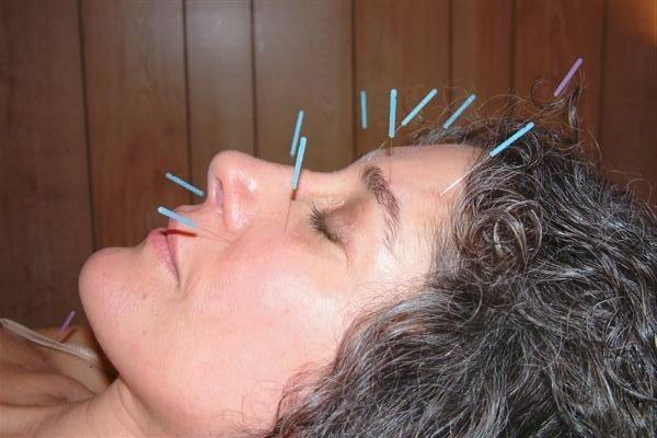 Akupunktur tedavisi